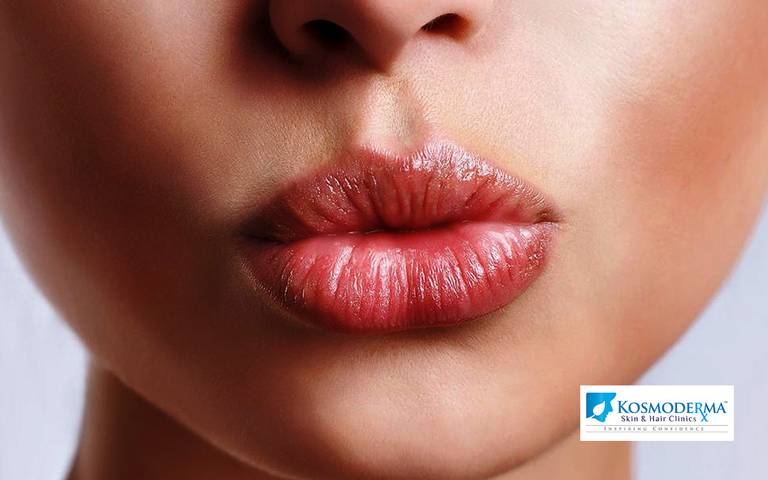 ‘Beautify’ Your Pout! | Kosmoderma