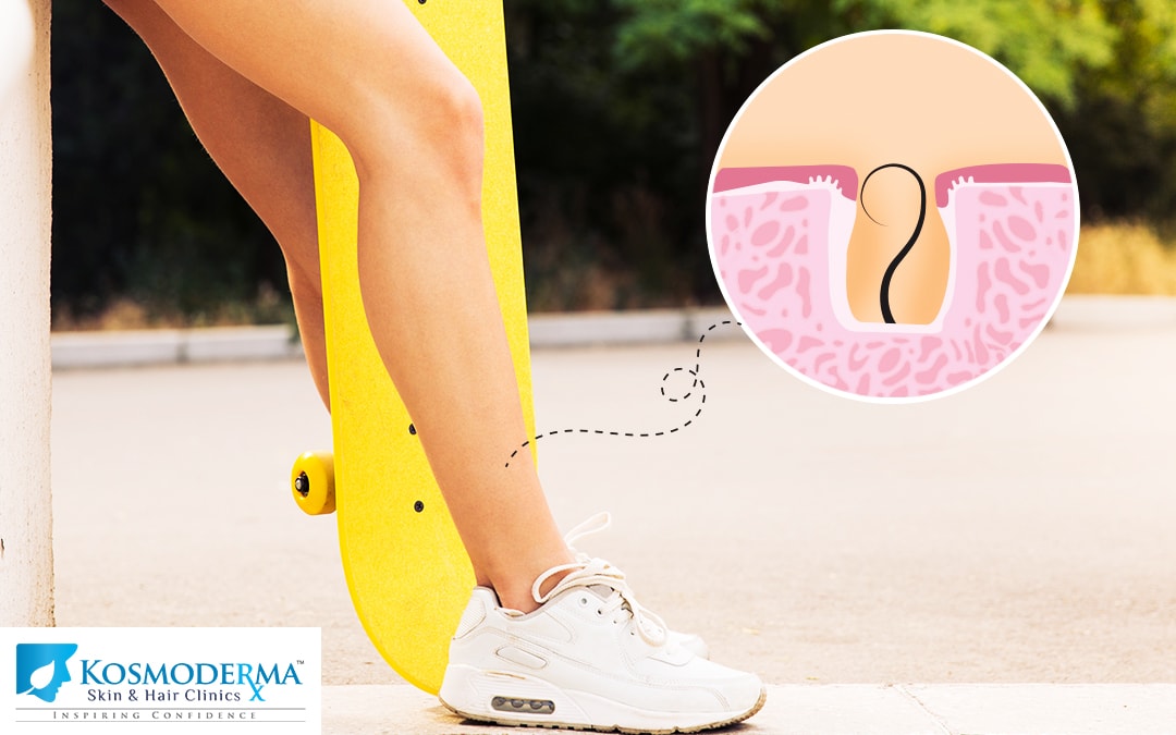 Ouch!!!… Are You Suffering From Ingrown Hair? | Kosmoderma