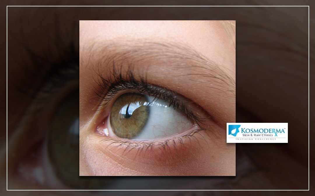 Hair loss in your Eyebrows- Don’t let your expressions fade away | Kosmoderma