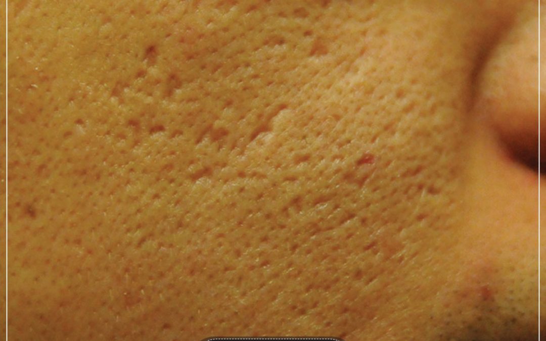A Guide to your Acne Scars | Kosmoderma