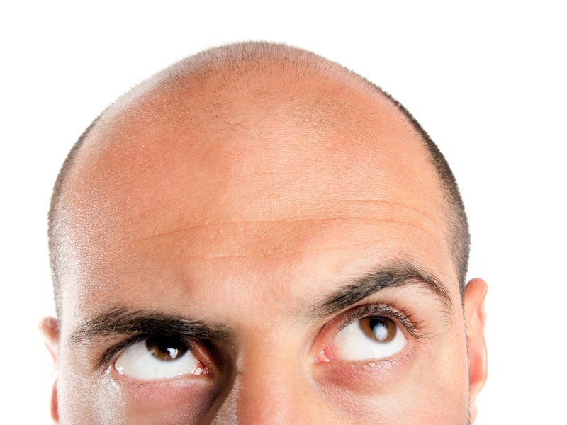 5 Reasons why You Should NOT be Bald Anymore! | Kosmoderma