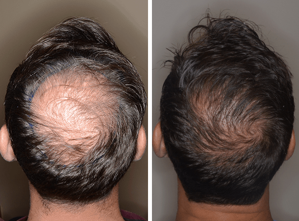 Pros and Cons of Hair Transplant | Kosmoderma