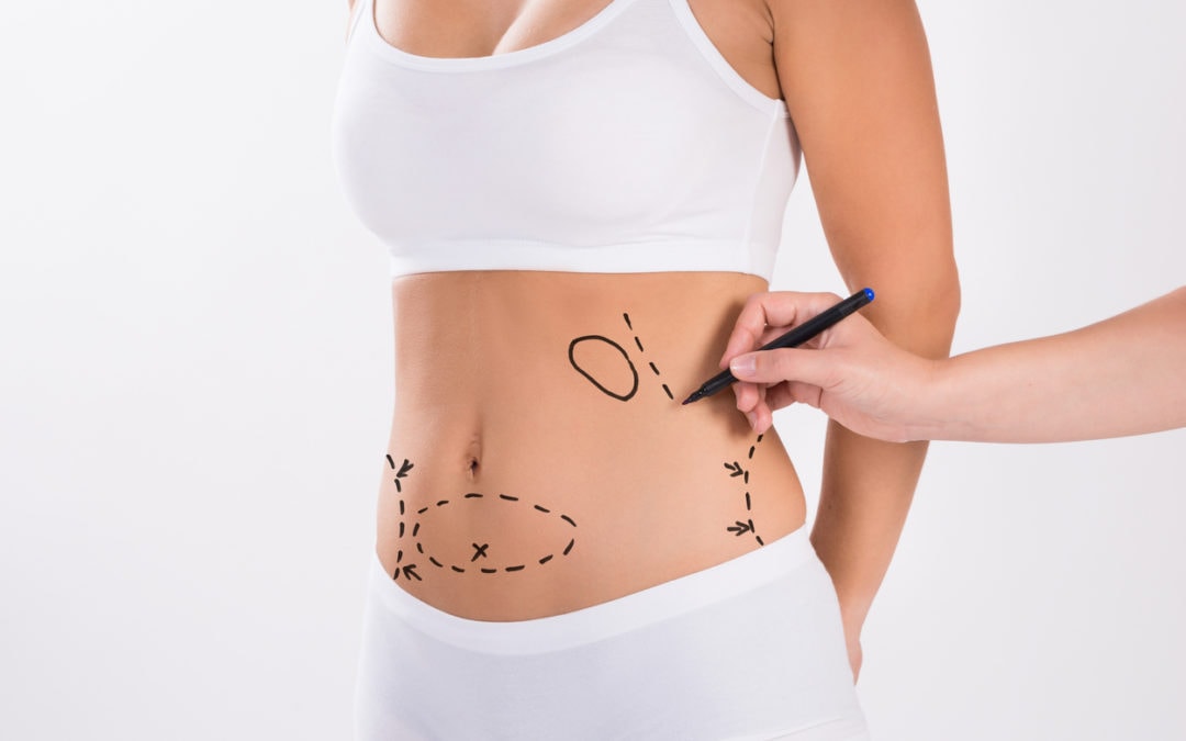 How is liposuction done? And when can I expect the results. | Kosmoderma