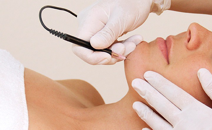 Everything You Need to Know Before You Get Electrolysis Hair Removal | Kosmoderma