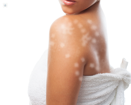 White patches or White Spots on Skin? Here are the possible causes and treatments for it | Kosmoderma