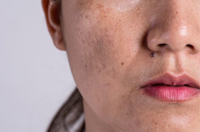 The Impact of Melasma on Mental Health | Kosmoderma
