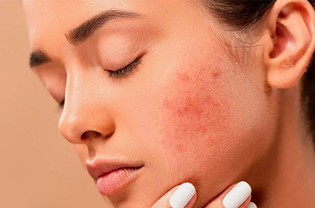 Effective and Safe Treatment for Acne | Kosmoderma