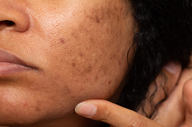 Here’s How Melasma Treatments In Chennai Can Help You! | Kosmoderma