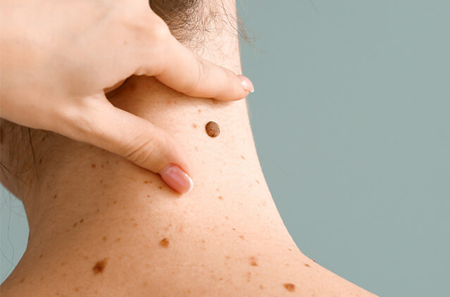 Tabulated: The Various Skin Tag Removal Methods In Chennai | Kosmoderma