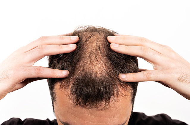 Disclosed: Causes, Symptoms, And Treatments Of Alopecia Areata Hair Loss | Kosmoderma