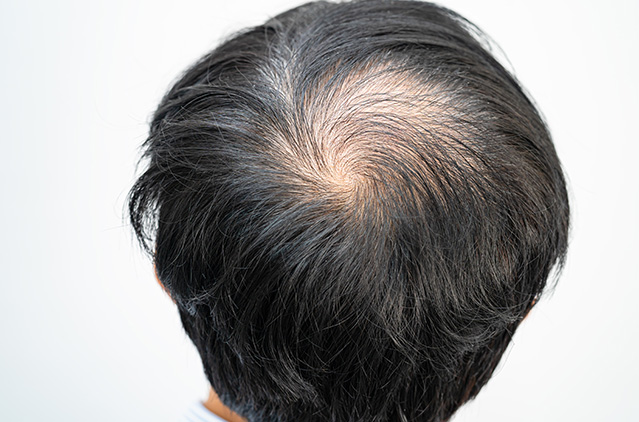 Listed: Varied Hair Loss Treatments For Alopecia Areata | Kosmoderma