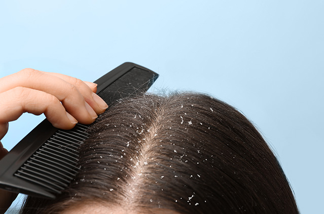 Anti-dandruff Shampoos Are Your Best Bet To Treat Dandruff! | Kosmoderma