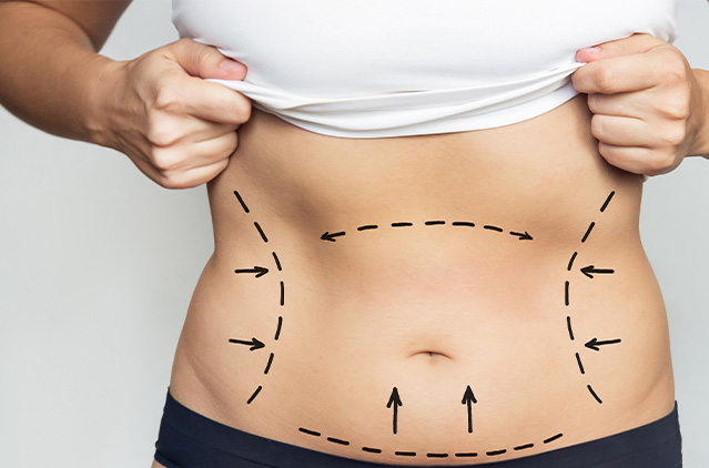 Liposuction and Tummy Tuck Surgery: Important Facts About Both Procedures! | Kosmoderma
