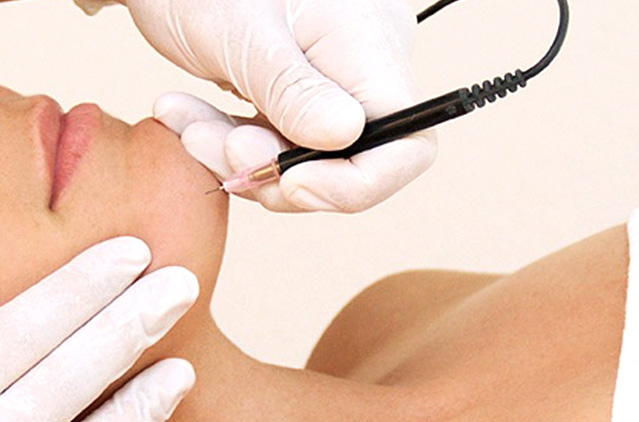 Hair Removal by Electrolysis in Chennai | Kosmoderma