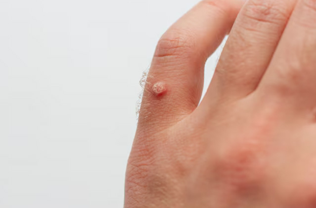 Say Goodbye to Warts: Expert Warts Removal in Chennai | Kosmoderma