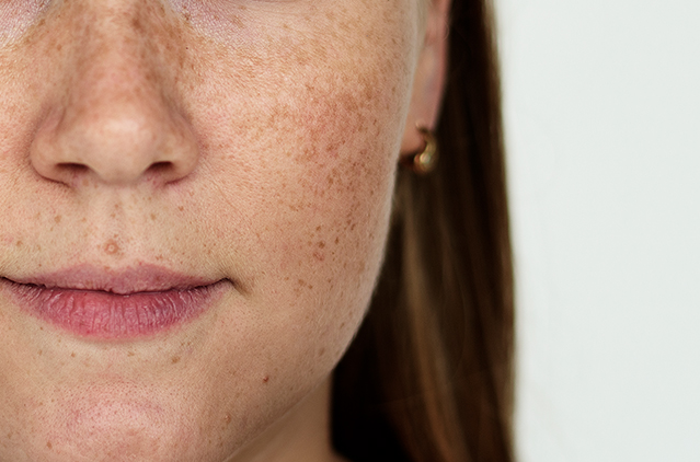Lasers for Dark Skin Hyperpigmentation: Advanced Treatment Guide | Kosmoderma