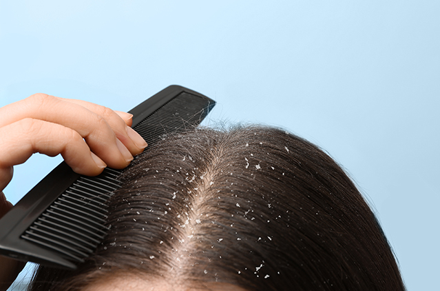 Dermats Decode Quickest and Most Efficient Treatment for Dandruff | Kosmoderma