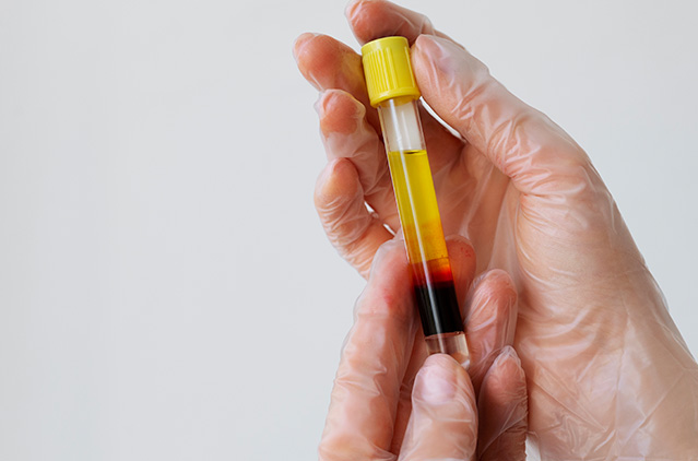 The Wondrous Benefits Of Prp Hair Loss Therapy! | Kosmoderma