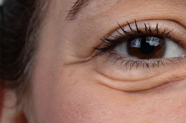 Have You Heard About These Revolutionary Tear Trough Treatments? | Kosmoderma