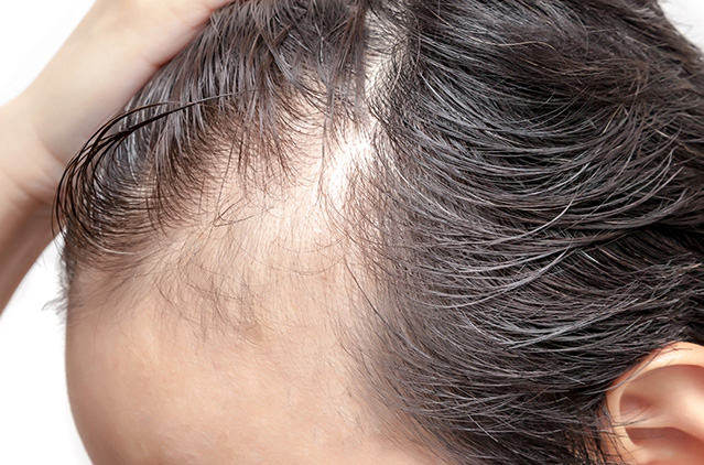 Qr678 Hair Treatment – For Natural-looking Hair Growth Outcomes For Men And Women! | Kosmoderma