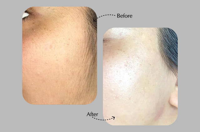 Featured: The Before And After Results Of Salmon Sperm Facials! | Kosmoderma