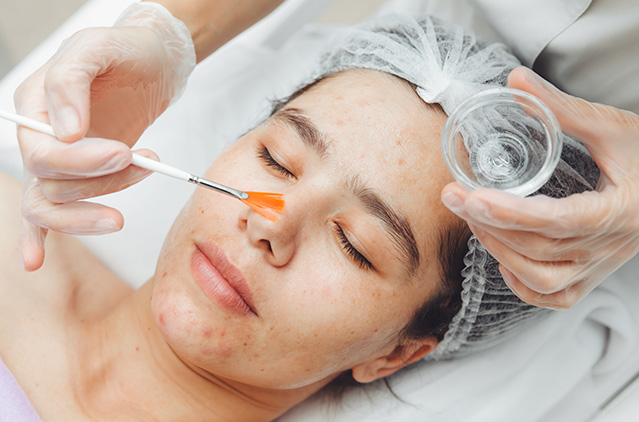 Chemical Peel Treatment In Bangalore: Get Rid Of Your Skin Blemishes Seamlessly | Kosmoderma
