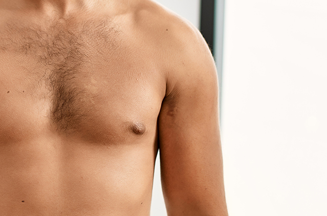 Gynecomastia Treatment in Bangalore: Cost, Safety & Real Results from Kosmoderma | Kosmoderma