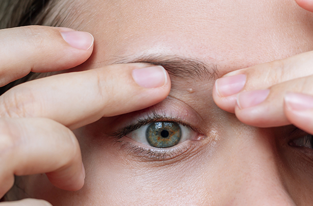 Milia Removal: Why Do Tiny White Bumps Appear on Skin? | Kosmoderma