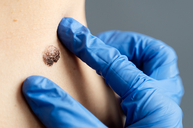 Lipoma vs. Cyst: How to Tell the Difference & Treatment Options | Kosmoderma