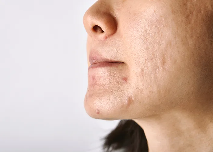Plastic Surgery for Acne Scars: Because You Deserve to Feel Good in Your Skin | Kosmoderma
