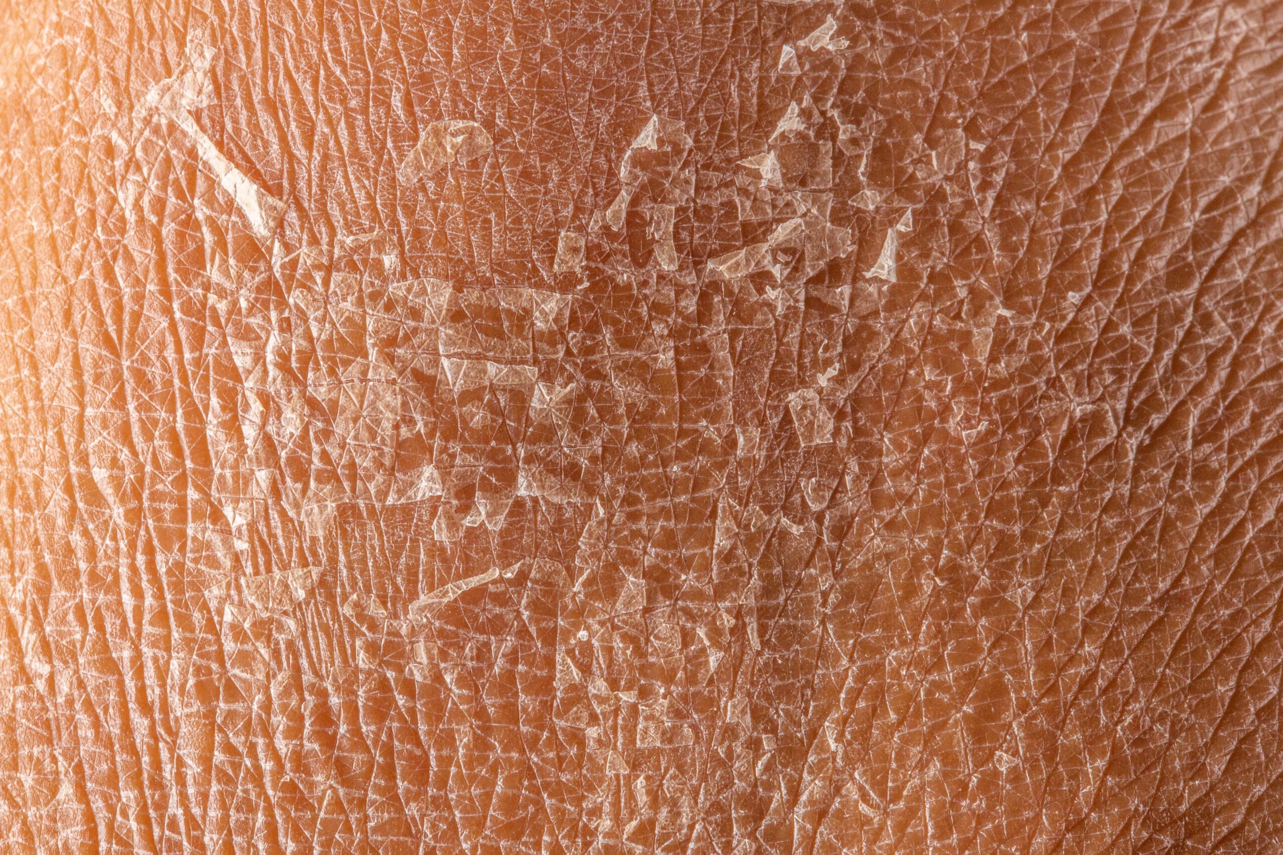 How to Cure Face Dryness in Winter – Fast & Effectively | Kosmoderma