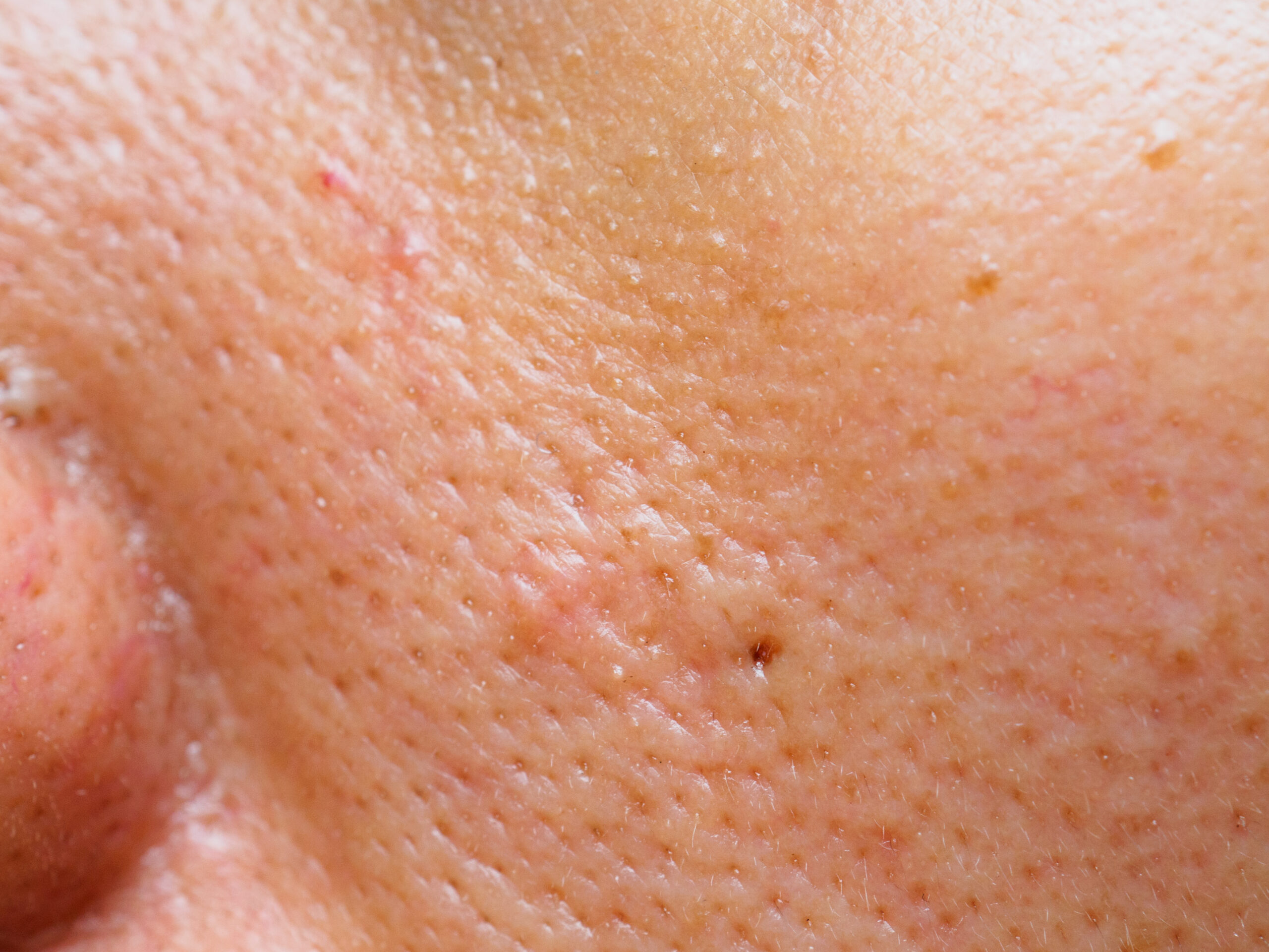 How to Reduce Open Pores on Face: Top Dermatologist-Approved Skincare Ingredients | Kosmoderma