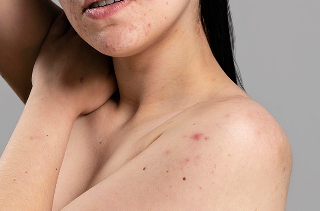 Effective Body Pimples Treatment: Causes & Skincare Routine | Kosmoderma