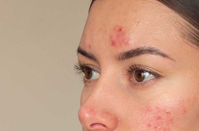 Forehead Pimples Treatment: Why Do I Keep Getting Pimples on My Forehead? Causes & Prevention Tips | Kosmoderma