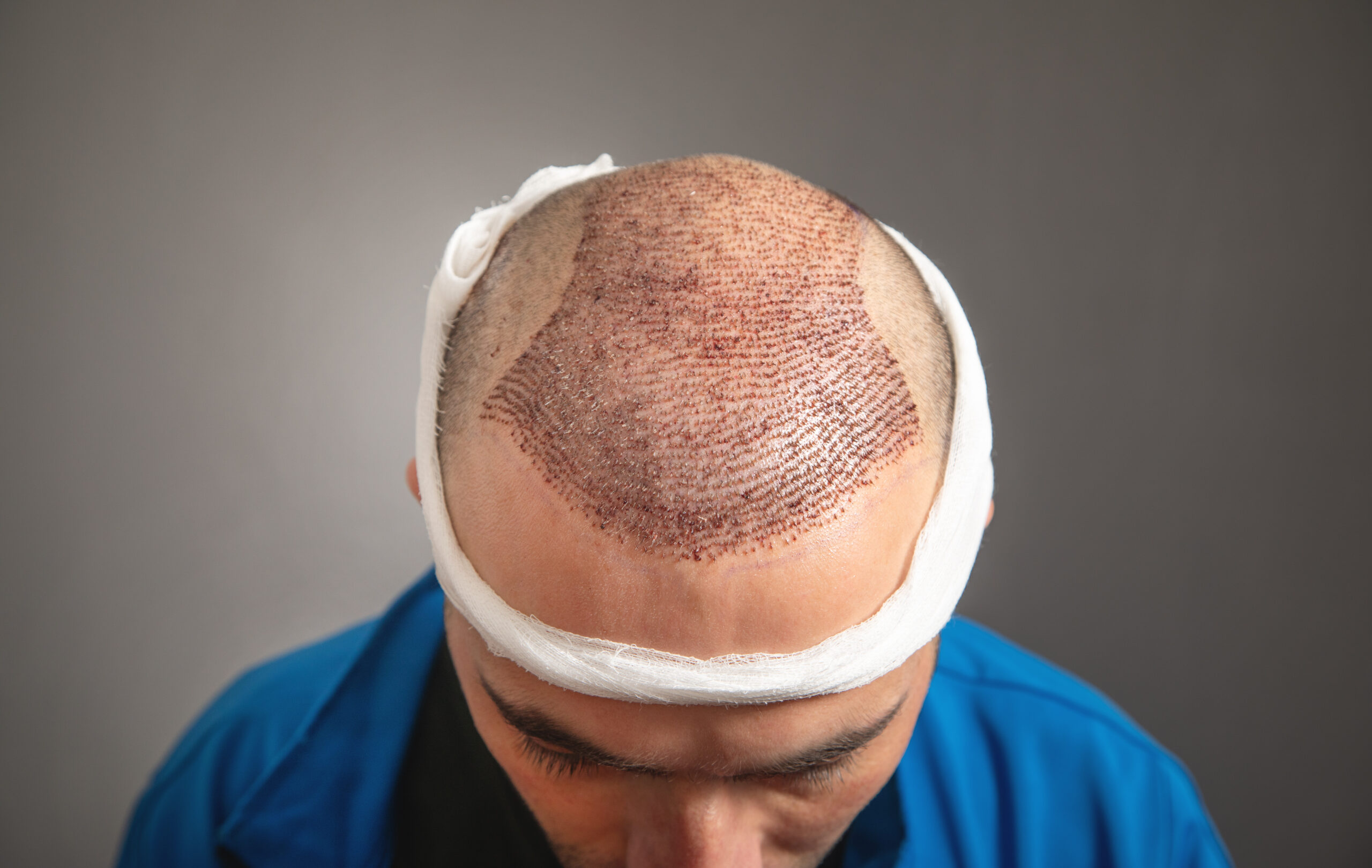 FUE Hair Transplant: The Ultimate Guide to Natural Hair Restoration | Kosmoderma