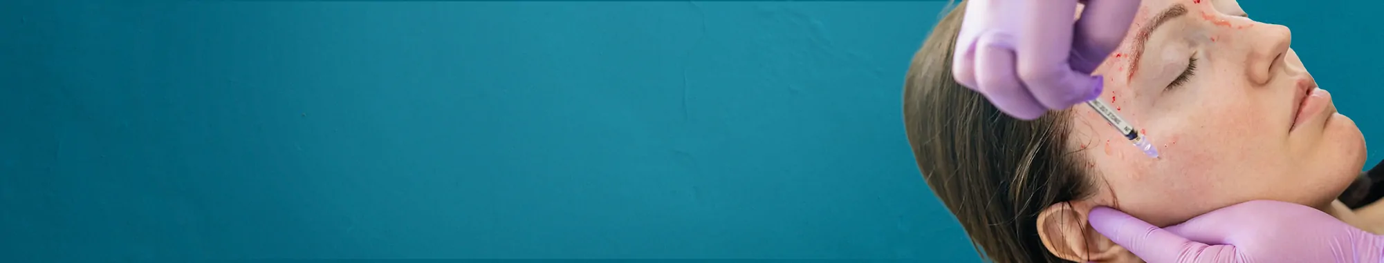 55-https___www.kosmoderma.com_treatment_vampire-face-lift-prp-facelift_36