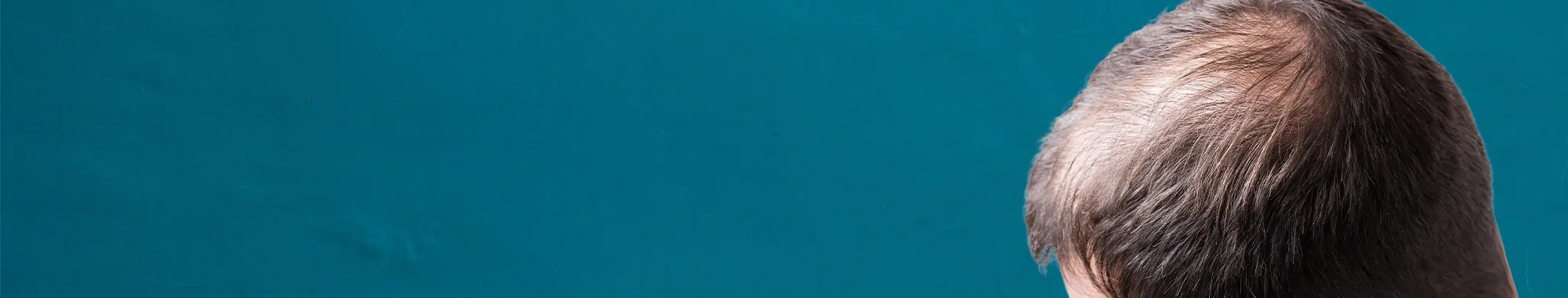 60-https___www.kosmoderma.com_treatment_hair-regenera-for-hair-thinning-alopecia-male-female-pattern-baldness_57