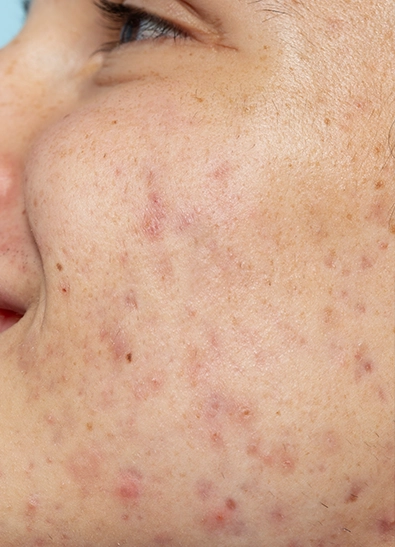 Acne and Pigmentation Treatment