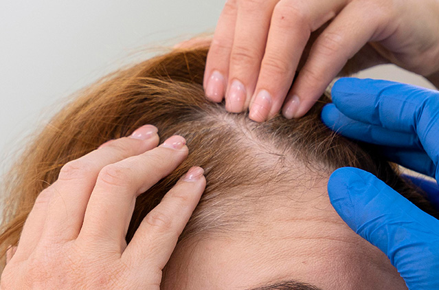 GFC Treatment For Hair Loss: Men’s Guide To Receding Hairlines! | Kosmoderma