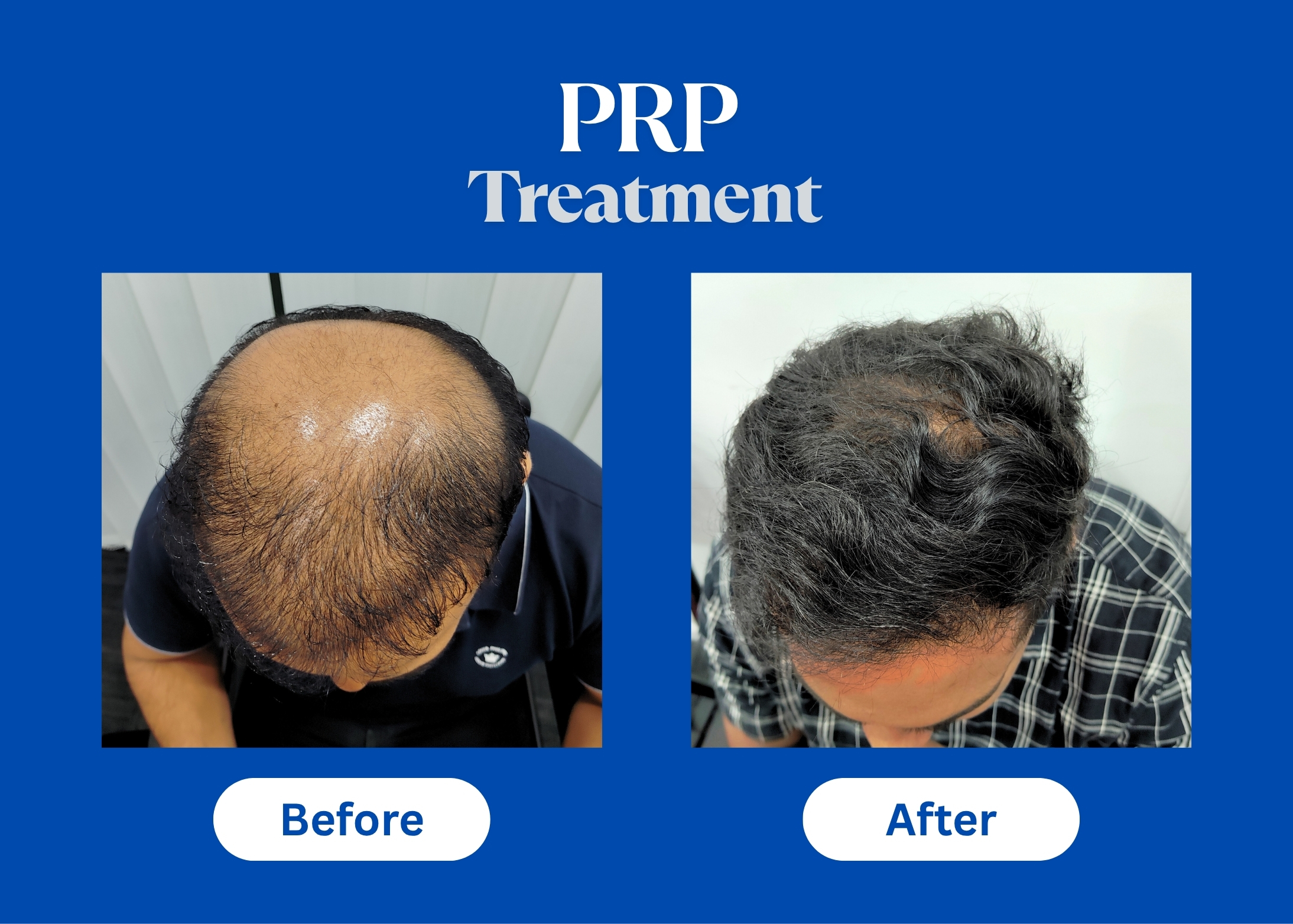PRP Before and After: What to Expect from Your Treatment Journey | Kosmoderma
