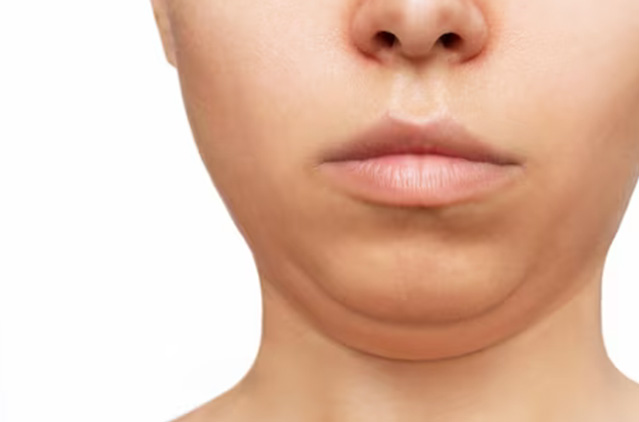 Your Guide to Facial Fat: Why It Collects Under the Chin & How Double Chin Removal Works | Kosmoderma