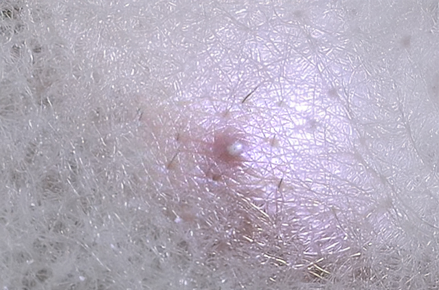 Best Ingrown Hair Treatment in Bangalore: Causes, Costs & Expert Clinics | Kosmoderma