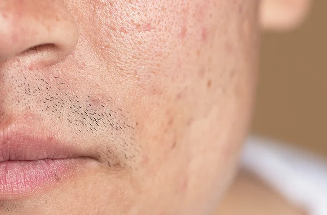 Open Pores on Face: Causes—Why They Happen & How to Reduce Them | Kosmoderma