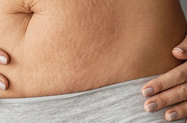 How to Remove Stretch Marks from Hips — Causes, Treatments, and Prevention | Kosmoderma