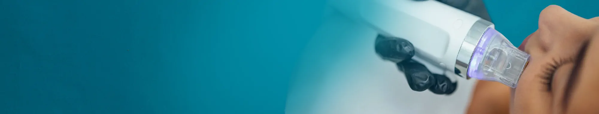 50-https___www.kosmoderma.com_treatment_mnrf-microneedling-radiofrequency-for-scar-resurfacing_05